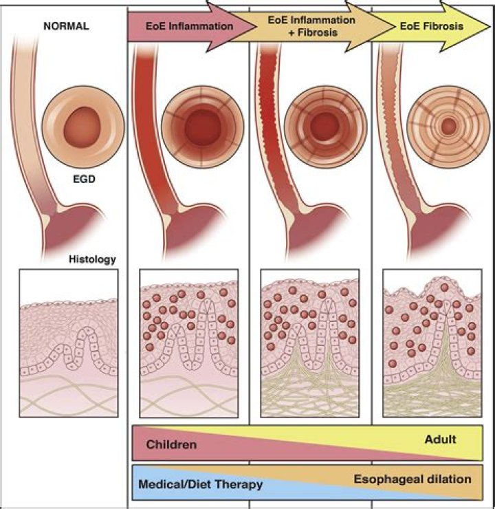 Can EoE turn into cancer?