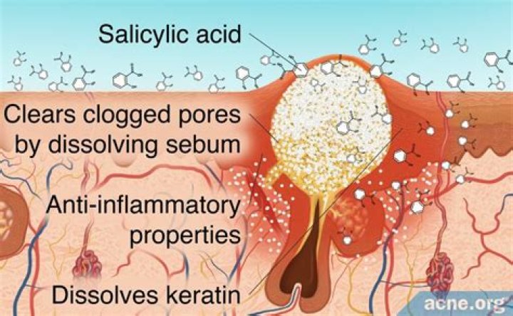 Does proactive contain salicylic acid?