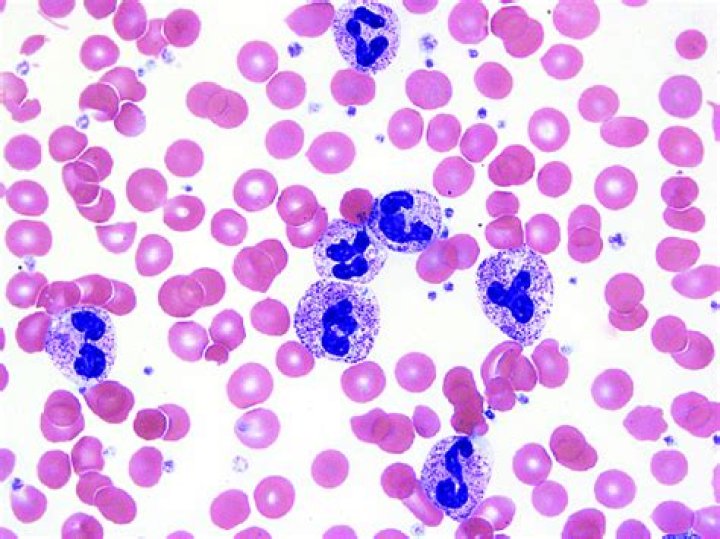 What causes neutrophil toxic granulation?