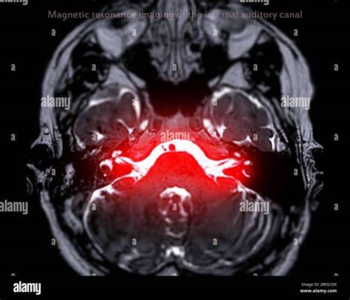 What is IAC brain?